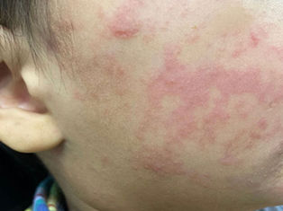 Health authorities urge Spartanburg residents to get the measles vaccine