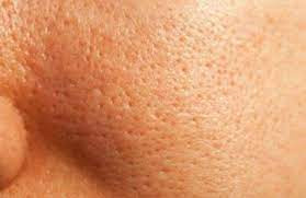 Piel grasa