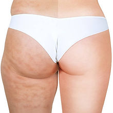 cellulitte.jpg