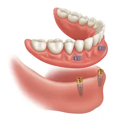 implant dentures