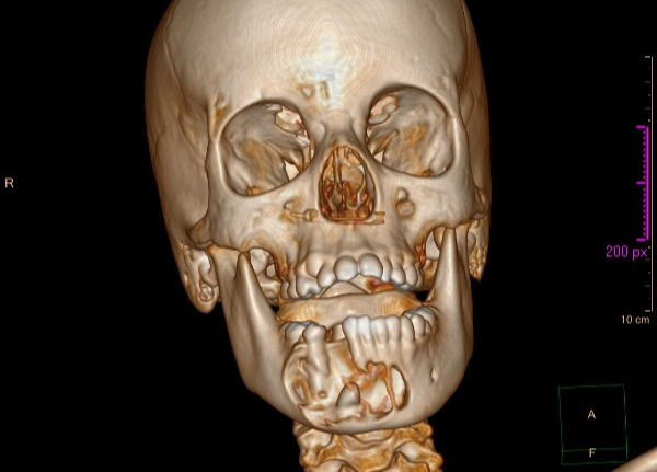 Tumor em Mandibula