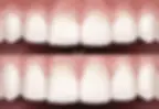 Gengivoplastia