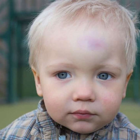 Remedios para eliminar los chichones en los niños