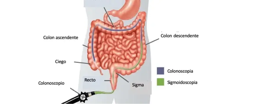 Colonoscopia.jpg.webp