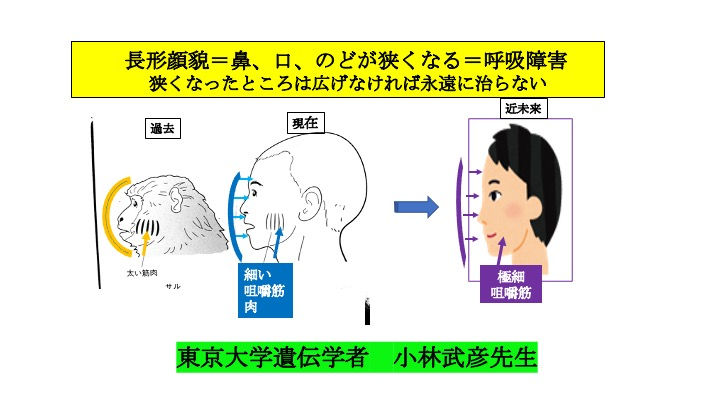 日本人の骨格は受け口、歯並びは出っ歯」パート９