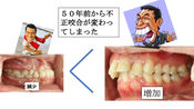 「骨格は受け口、歯並びは出っ歯」パート3