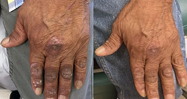 after psoriasis_edited.jpg