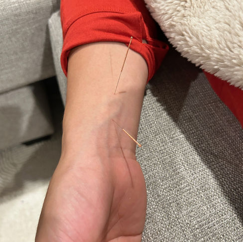 Close-up of acupuncture needles placed at PC6 on the inner forearm.