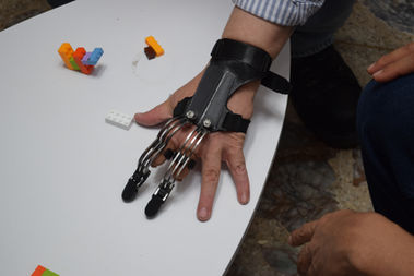 Mano con prótesis parcial