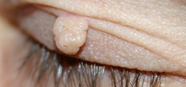 Fibromas on Face_edited.jpg