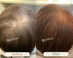 OiN Hair professional hair restoration results, showcasing real cases of healthy hair volume restoration.