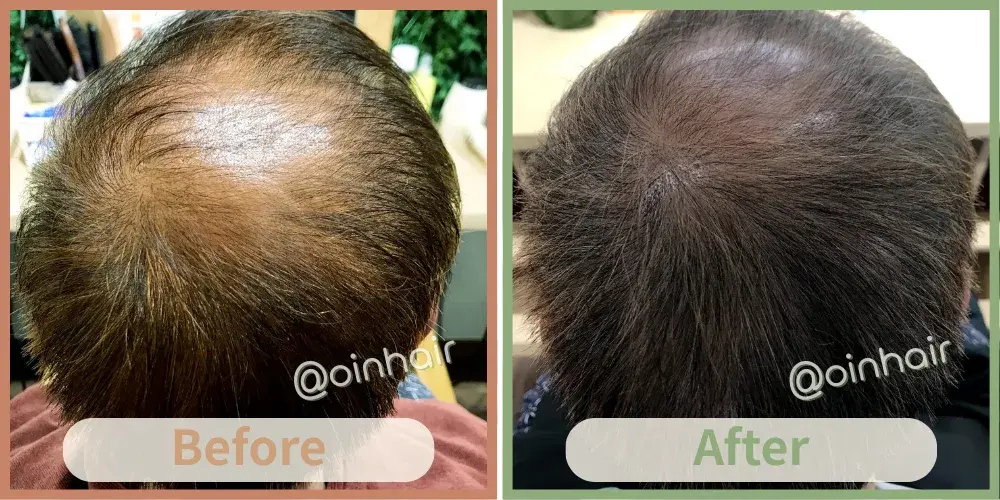 OiN Hair 雄性禿中期修復案例 - 激活地中海萎縮毛囊，重拾秀髮自信