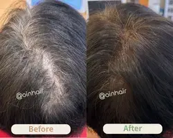 OiN Hair professional hair restoration results, showcasing real cases of healthy hair volume restoration.