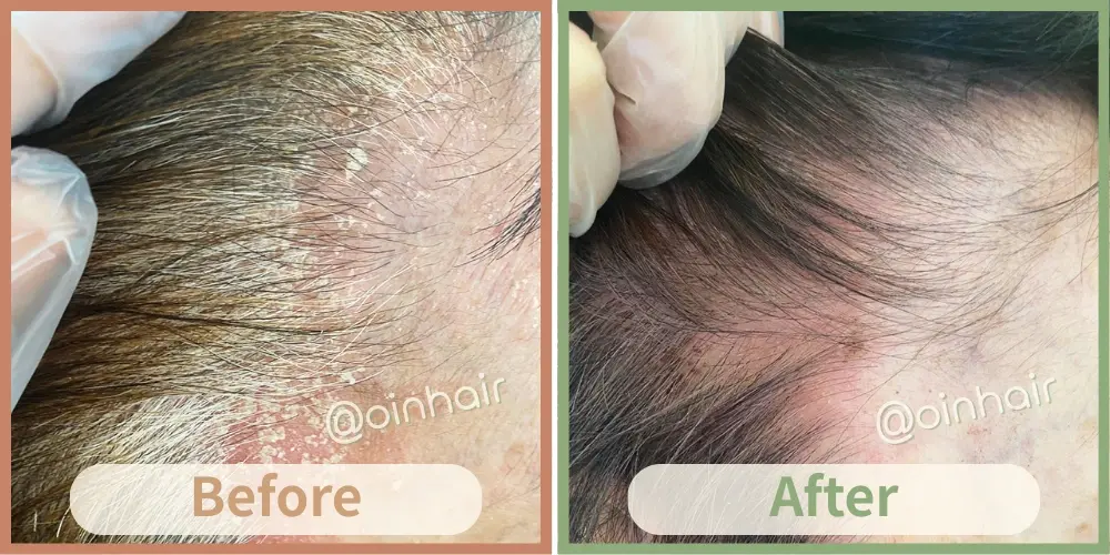 OiN Hair 化學染後頭皮濕疹修復 - 舒緩紅腫癢癢，重建頭皮健康屏障