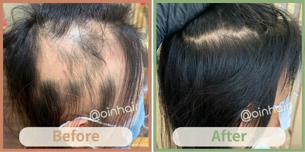 OiN Hair 頑固斑禿修復實測 - 20種名貴草本深層調理，改善斑禿/鬼剃頭問題