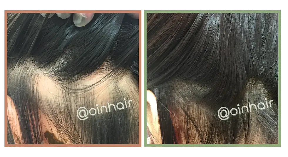 alopecia-areata-recovery-herbal-treatment-oin-hair.webp