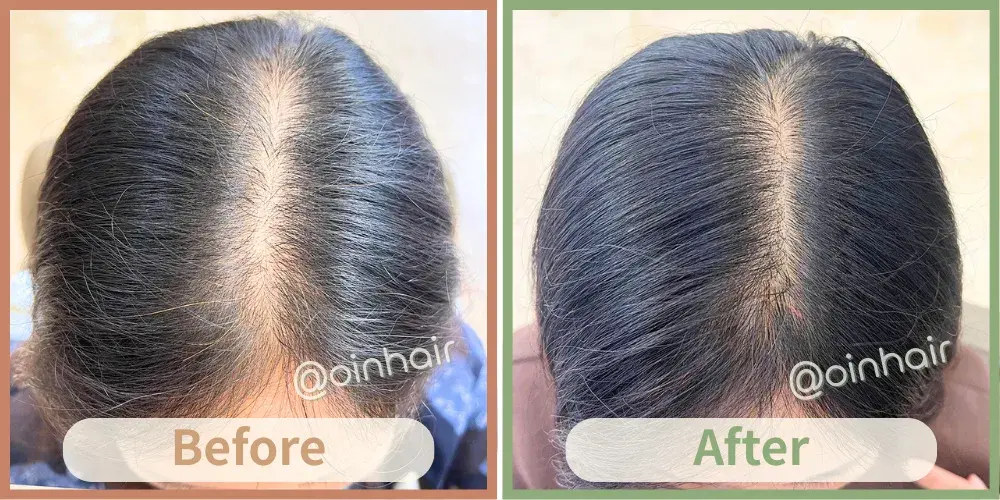 OiN Hair 女士脫髮修復見證 - 解決分界線明顯稀疏，改善頭頂髮量