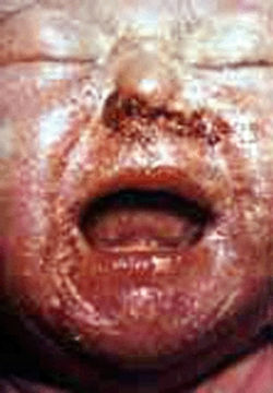 sifilis-en-el-embarazo