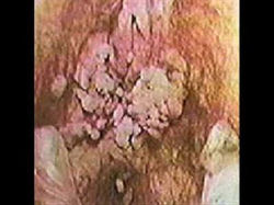 sifilis vaginal