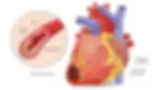 Illustration of a heart with labeled parts: healthy muscle, coronary arteries. Inset shows artery with cholesterol and blood clot, leading to dying muscle.