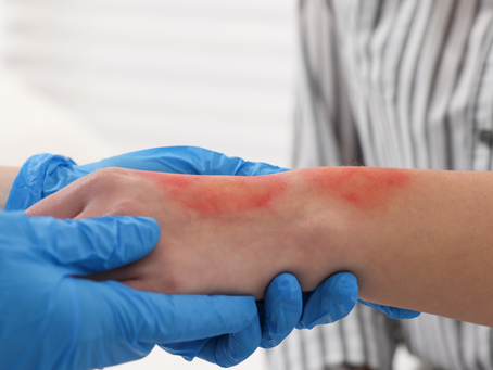 Long-Term Effects of Burn Injuries