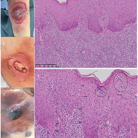 Pyoderma gangrenosum ulcer with a dark violet border on a limb, beside a skin biopsy slide showing dermal inflammation