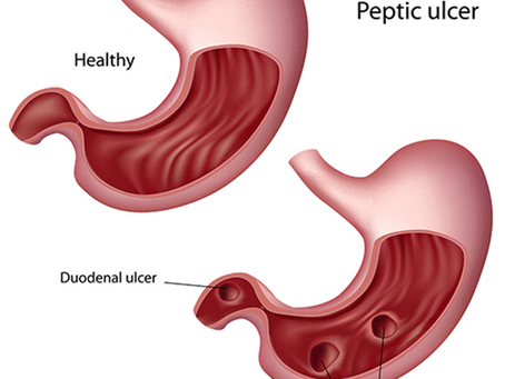 Understanding Peptic Ulcers and Heartburn