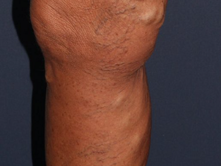 Let’s Learn About Varicose Veins