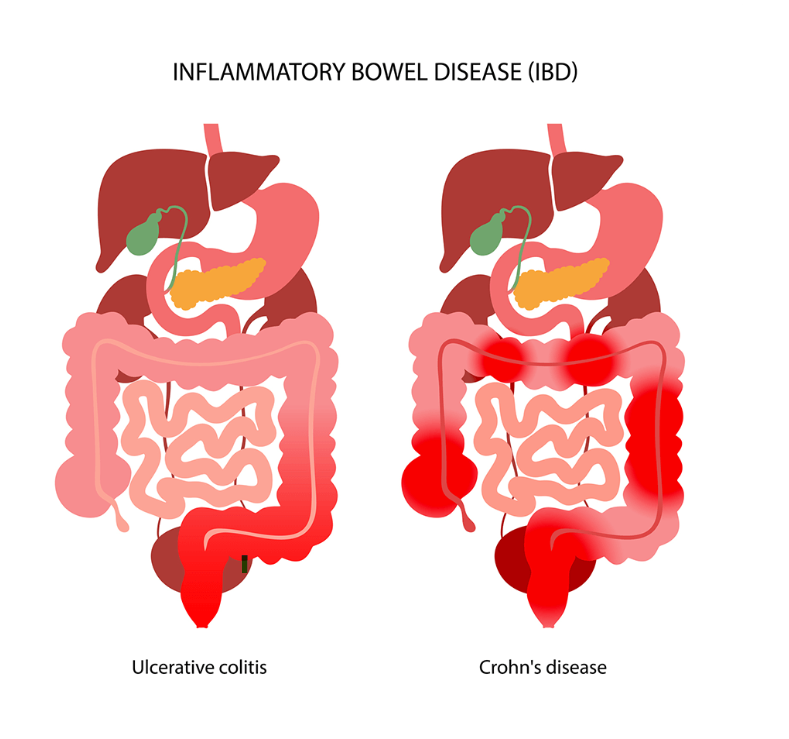Image 1: Inflammatory Bowel Disease