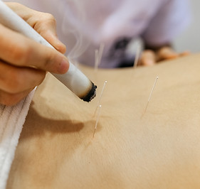 Woman being treated with acupuncture and moxibustion treatments.jpg