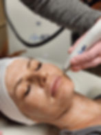 AgeJet Plasma skin treatment being done on a patient at Bloom Aesthetics