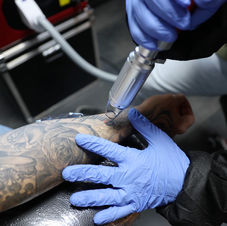 Laser tattoo removal treatment