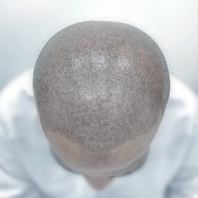 Patient head after SMP