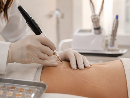 Scar Camouflage in Dubai: Does It Work for Scars and Stretch Marks?