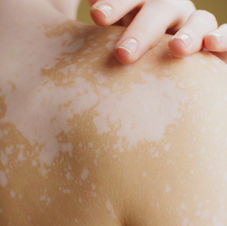 Person's shoulder with vitiligo patches