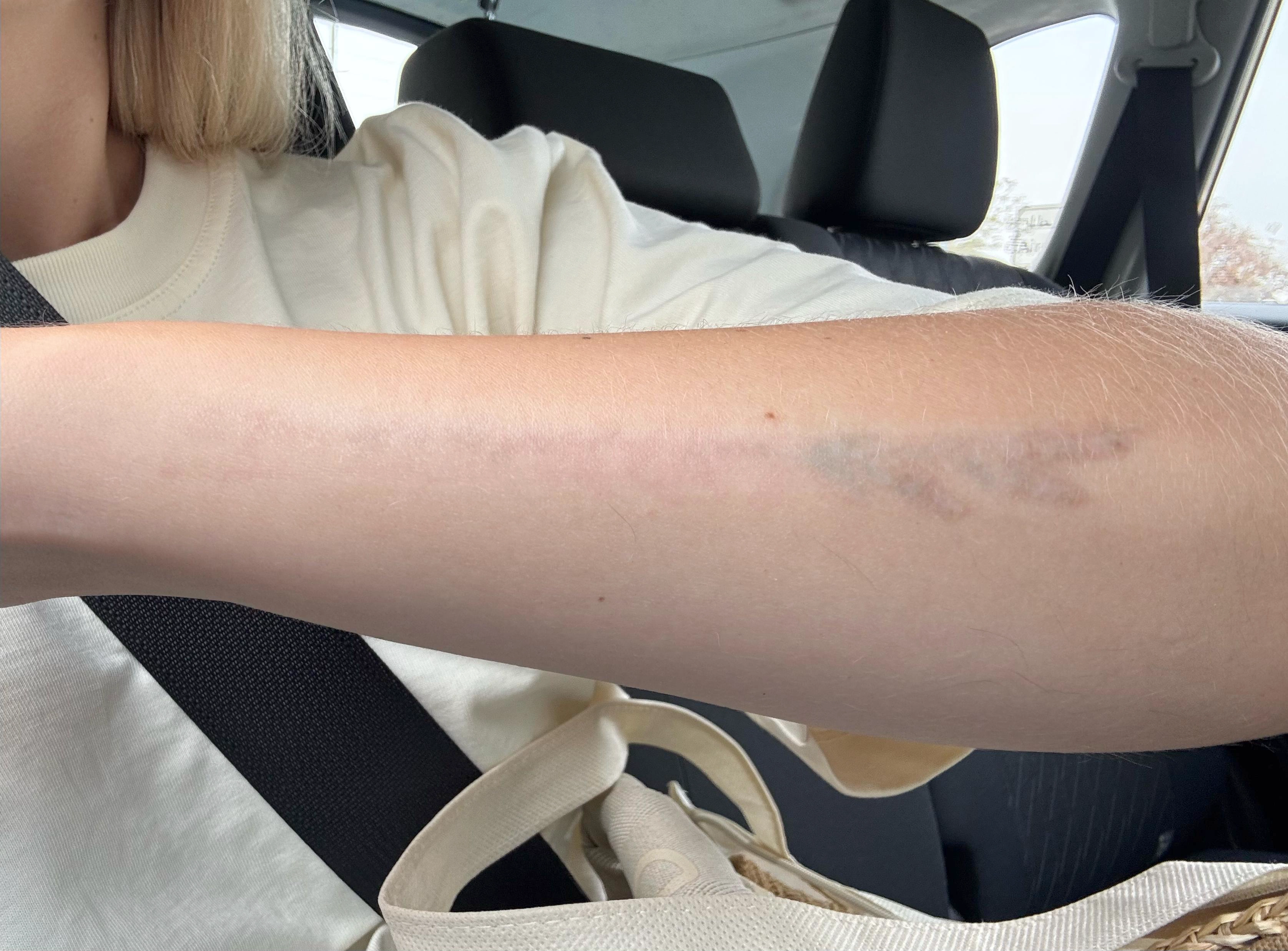 removed tattoo co2 fractional laser