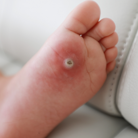 Understanding Corns, Callosity, and Viral Warts: Causes, Symptoms, and Treatment