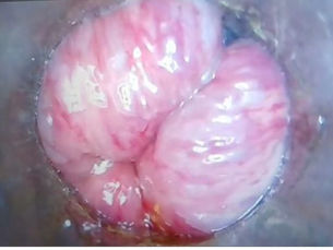 Video Proctoscopy: Revolutionizing the Diagnosis of Procto-Anal Disorders