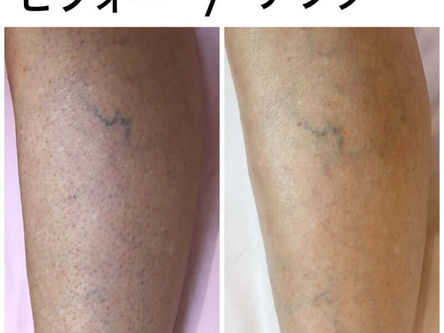 ひざ下脱毛