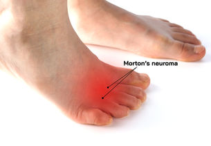 Mortonse neurologie