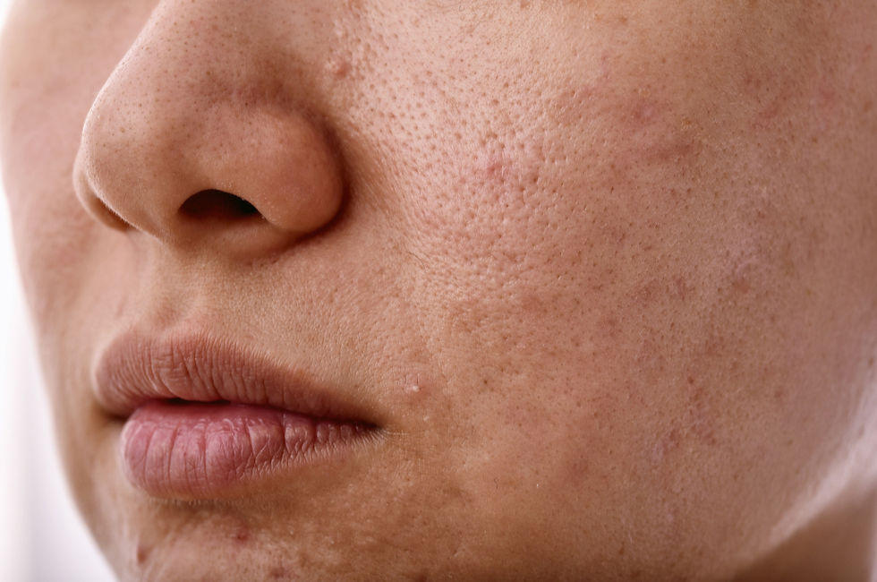 Close-up of dry, irritated facial skin representing common signs of a damaged skin barrier.