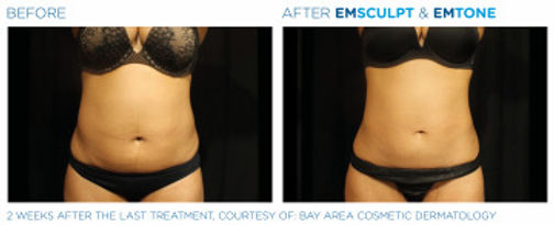 emsculpt before and after woman