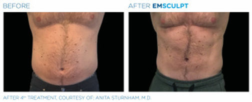emsculpt before and after man