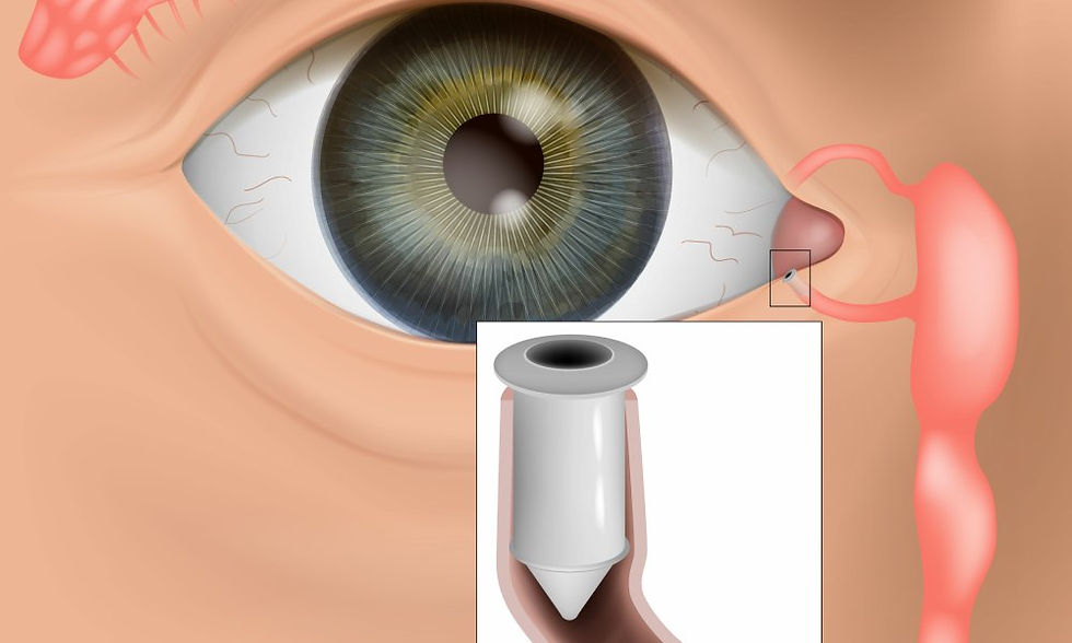 An image depicting a punctal plug to Dry Eye Disease