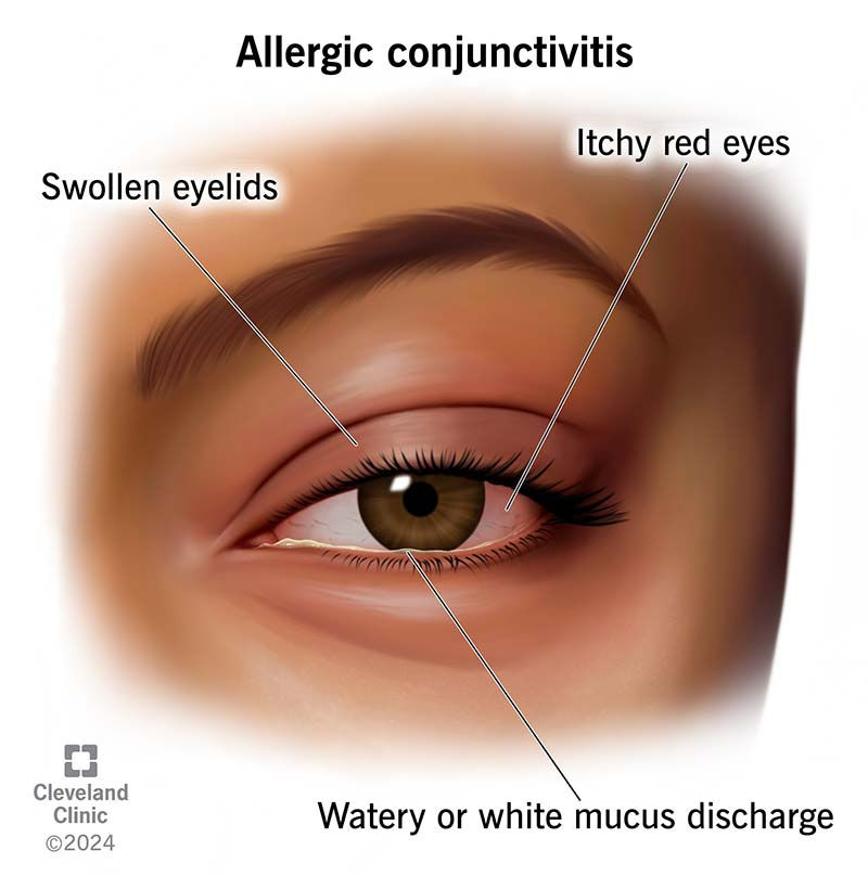 No More Eye-Ritation: Relief for Ocular Allergies