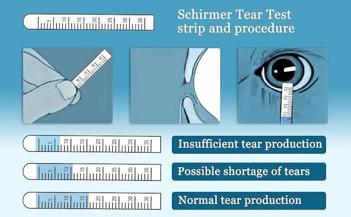 This is a diagram showing how the Schirmer's Test, tests for Dry Eye Disease.