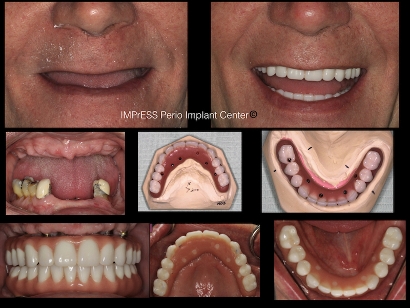 Full Mouth Implant Rehabilitation IMPrESS Perio Implant Center Dr. Noroozi.001
