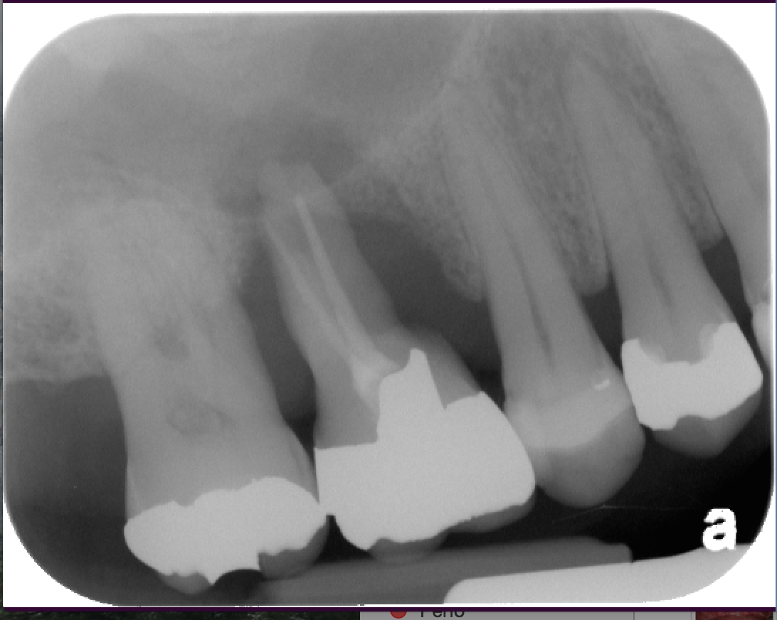 Perio Endo Lesion-Vertical Bone Loss