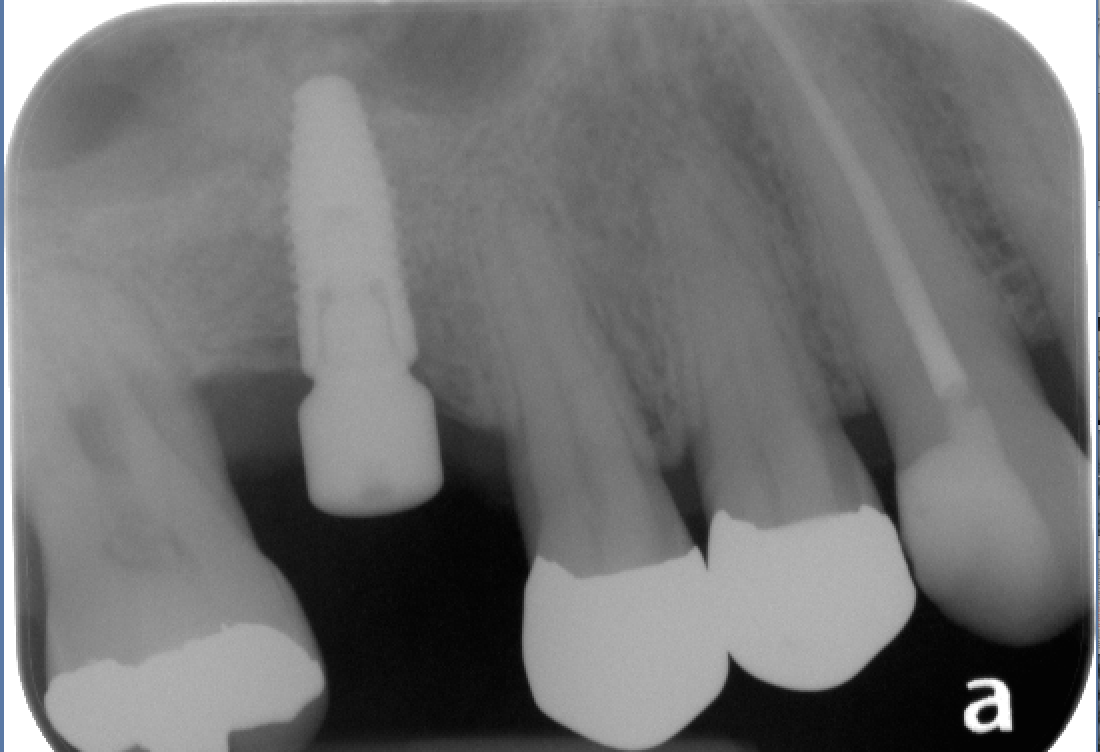 Vertical Ridge & Sinus Augmentation