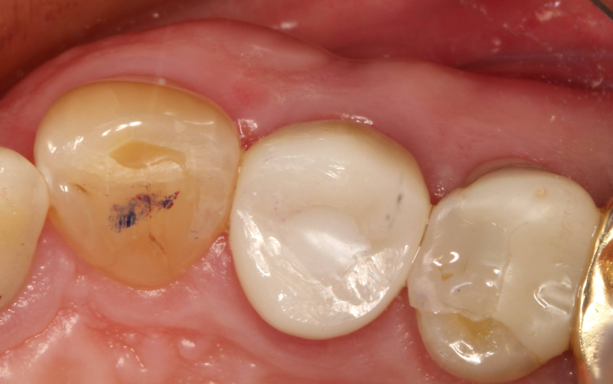 Implant Crown